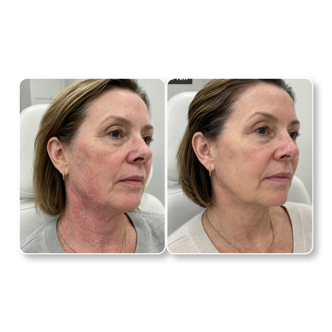 Before and after: red, flaking cheeks and neck calmed and even-toned