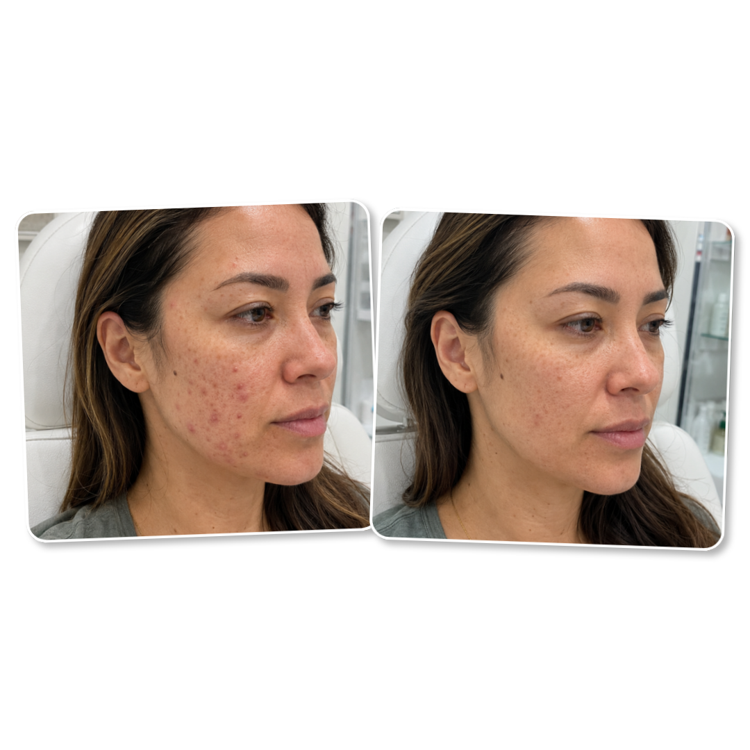 Before and after: active acne breakouts cleared to smooth skin